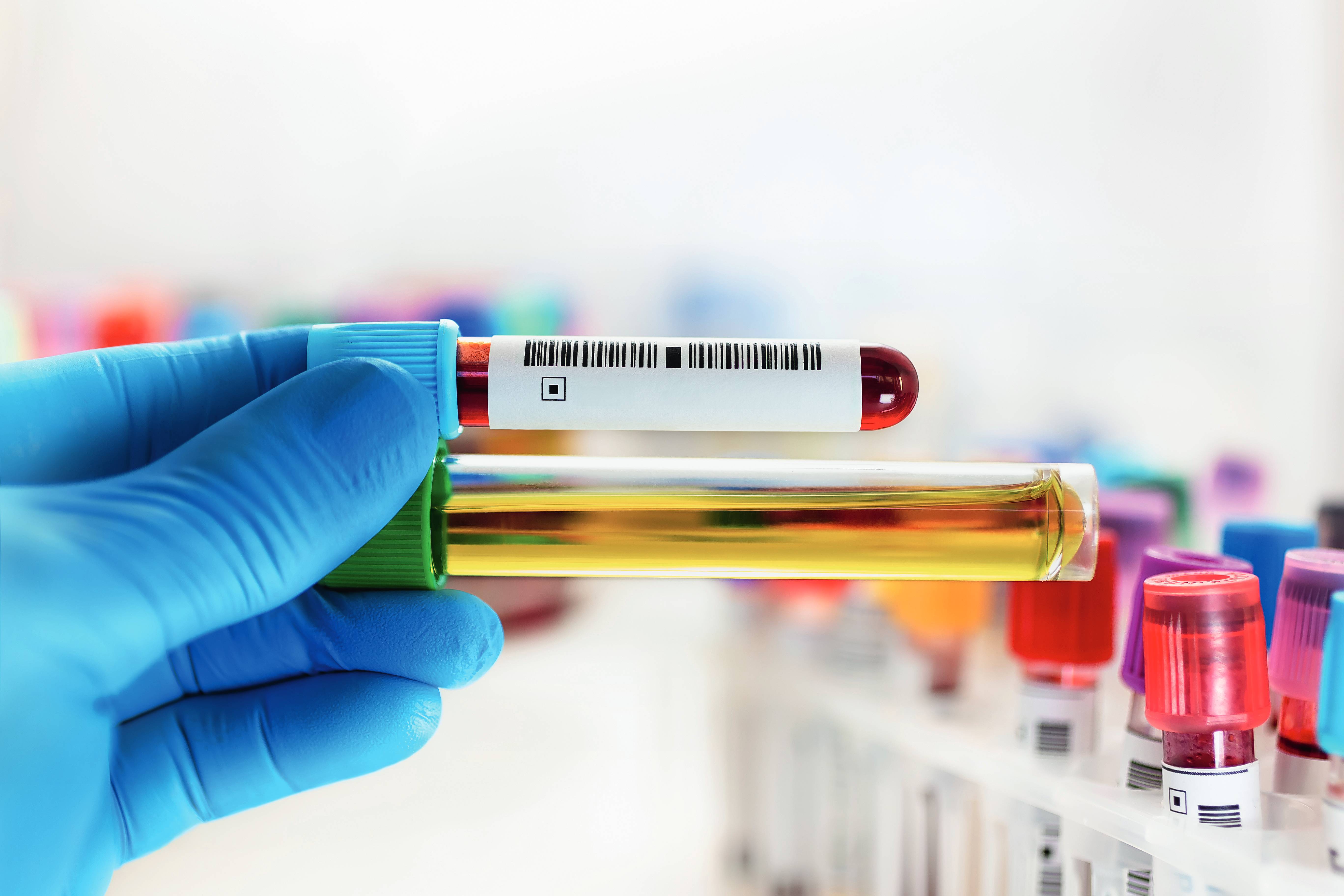 Så enkelt kan en folksjukdom upptäckas